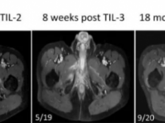 TIL疗法帮助晚期癌症患者完全缓解长达3.5年,这种新型免疫疗法针对多种实体瘤有效