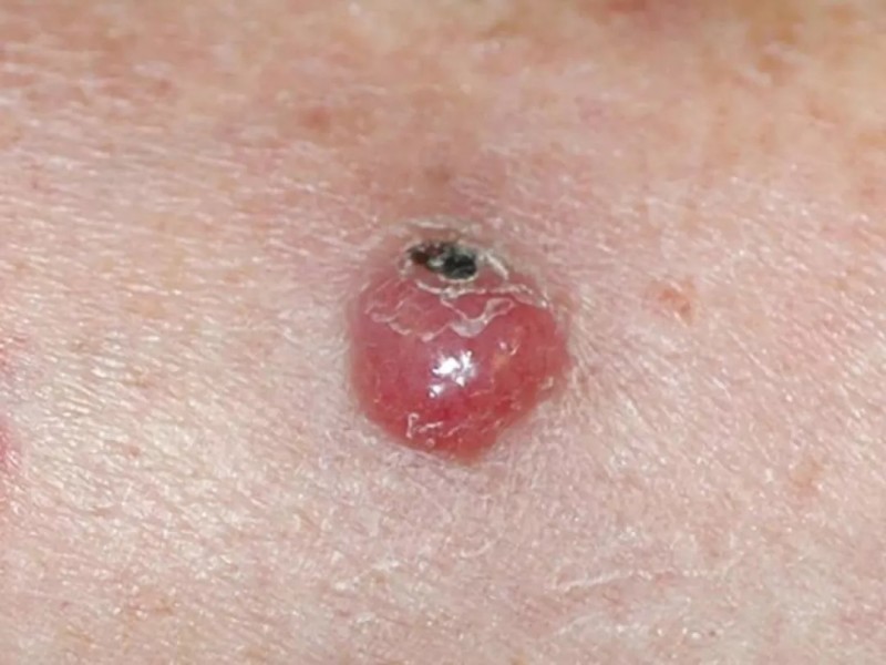 皮肤癌的早期症状表现图片