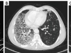EGFR20ins突变靶向药治疗肺癌难治突变34个月肿瘤扔可持续缩小,靶向治疗耐药的患者也能获益