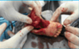 婴儿纤维肉瘤手术