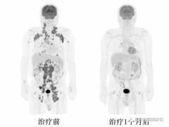 CART治疗效果完全缓解可达100%,2023年CAR-T细胞疗法重大突破盘点