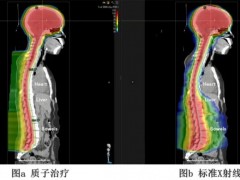 儿童肿瘤质子治疗,精准爆破肿瘤组织,降低放疗副作用提升疗效双保险