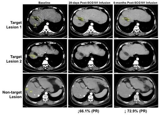 HBV相关肝细胞癌患者SCG101回输前后影像学变化