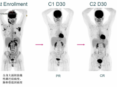 AFM13与NK细胞相结合客观缓解率高达97%,NK细胞疗法在哪些抗癌领域大放异彩
