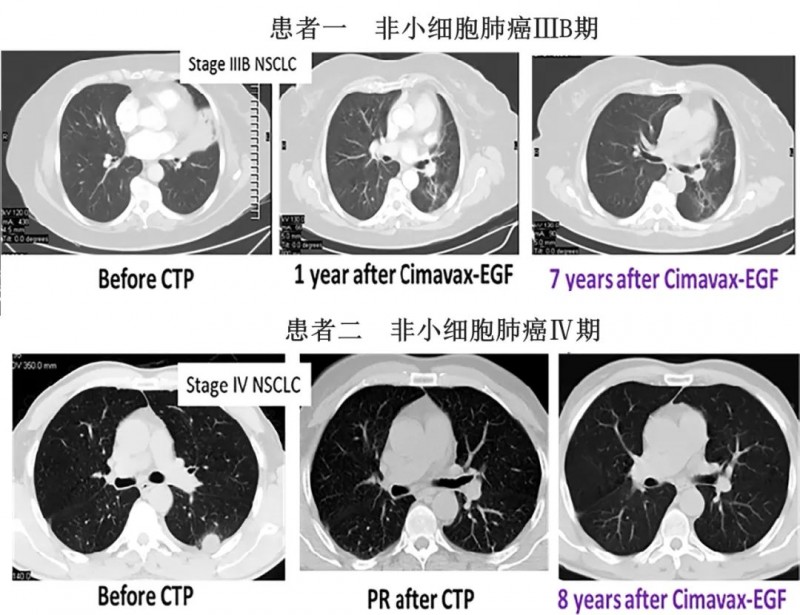 CIMAvax-EGF疫苗治疗非小细胞肺癌的效果