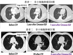 我国首款mRNA肿瘤疫苗冲击FDA,更多的肿瘤mRNA疫苗多点开花,剑指肺癌、胰腺癌、乳腺癌等