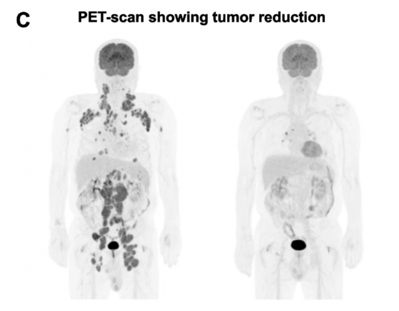 CAR-T细胞疗法AT101治疗淋巴瘤的效果
