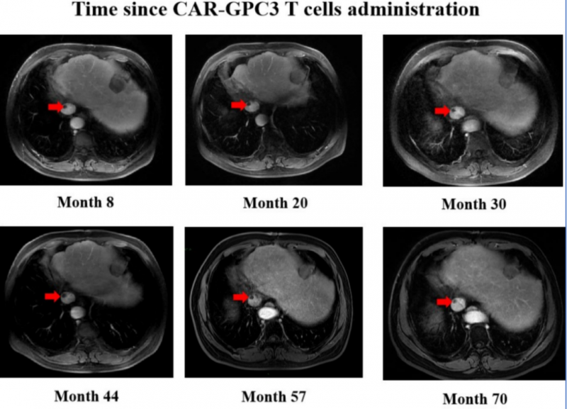 CAR-GPC3 T细胞治疗干细胞癌转移的效果