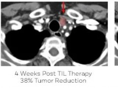 T细胞免疫疗法治疗胃癌、肝癌、宫颈癌等实体瘤抗癌力强劲