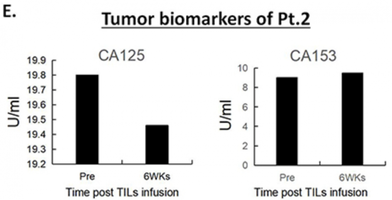 TIL细胞疗法治疗转移性宫颈癌的数据