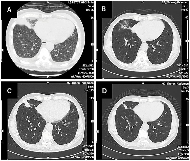 WT1-DC治疗肺癌胸部肿瘤缩小
