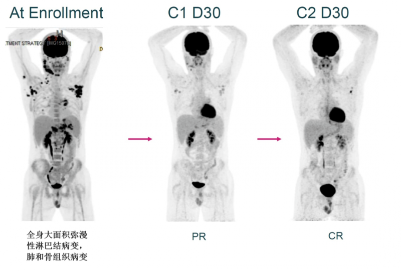AFM13-NK细胞疗法治疗高度难治性霍奇金淋巴瘤的效果