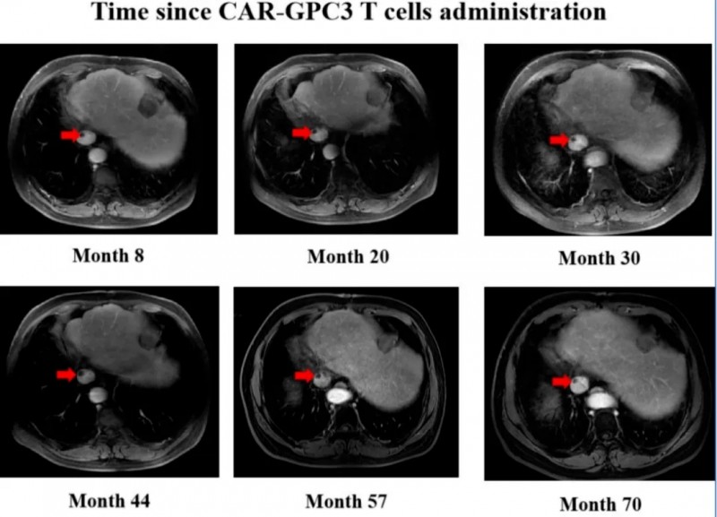 CAR-T疗法治疗晚期肝癌的效果