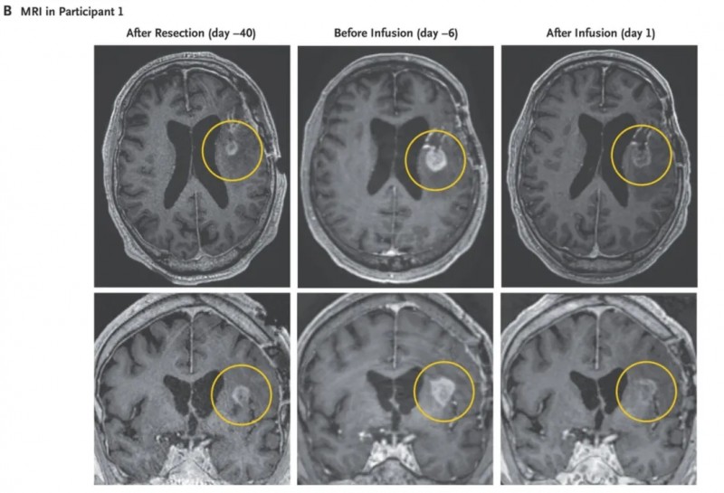 CARv3-TEAM-E T Cells治疗74岁脑胶质瘤患者的效果
