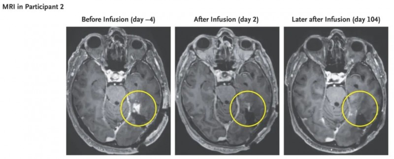 CARv3-TEAM-E T Cells治疗72岁胶质母细胞瘤的效果