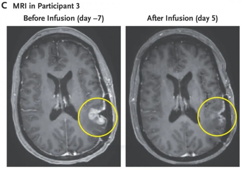 CARv3-TEAM-E T Cells治疗57岁女性胶质母细胞瘤的效果