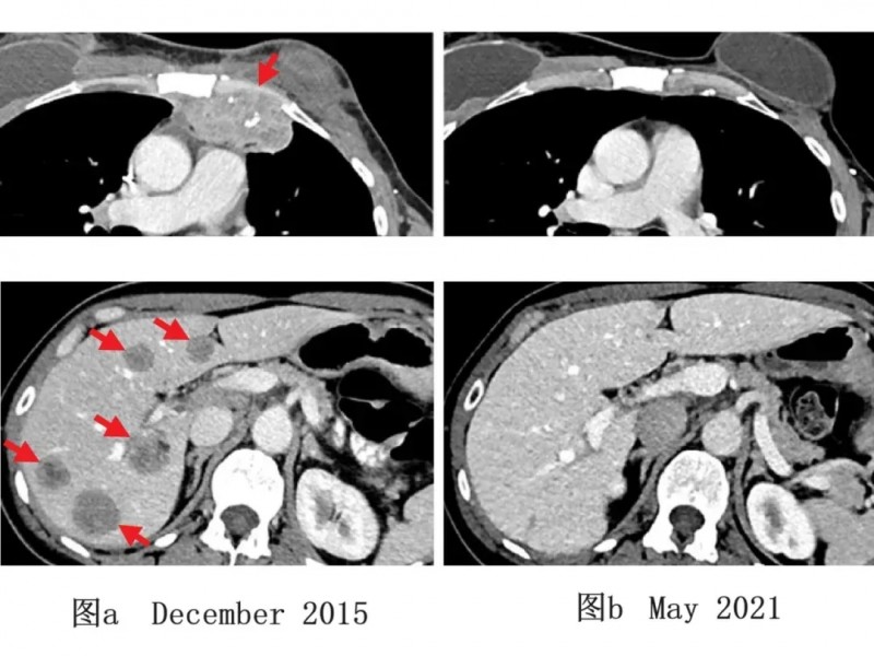 乳腺癌患者TIL治疗前后的影像学变化