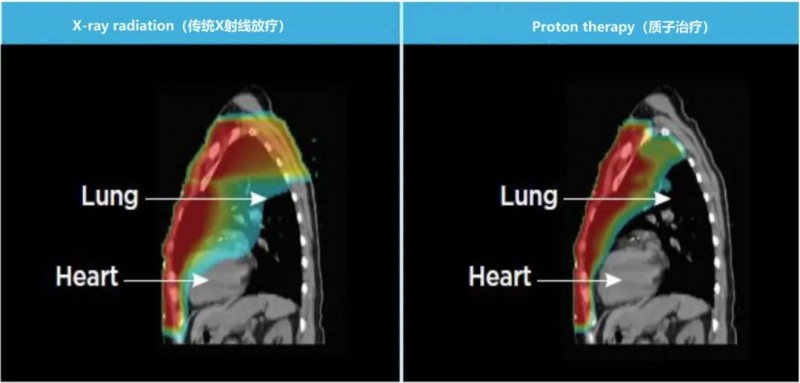 光子放疗与质子放疗在心脏和肺部结构上的差异