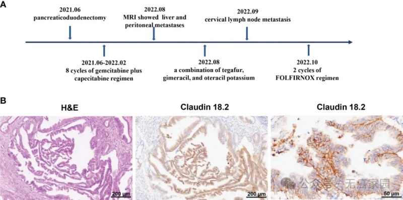 CLDN18.2 CAR-T治疗胰腺癌的效果