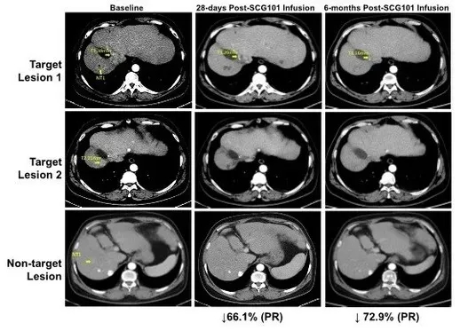 HBV相关HCC患者回输SCG101前后的影像学变化