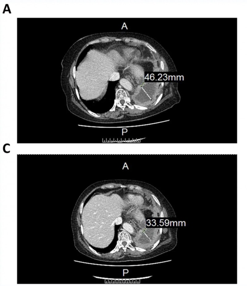 CCCR-NK92治疗晚期非小细胞肺癌胸腔积液的效果