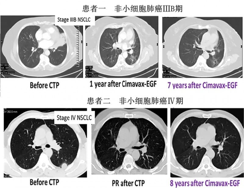 CIMAvax-EGF治疗肺癌的效果