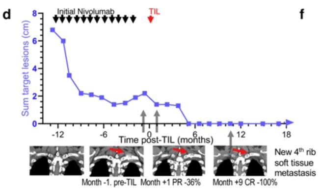 TIL细胞治疗PD-1耐药的转移性肺癌的效果