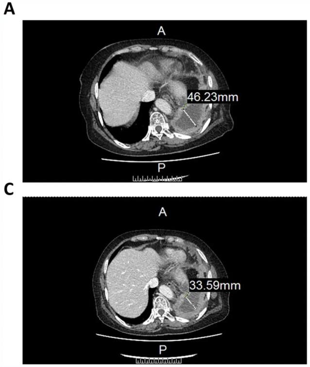 CCCR-NK92治疗晚期非小细胞肺癌的效果