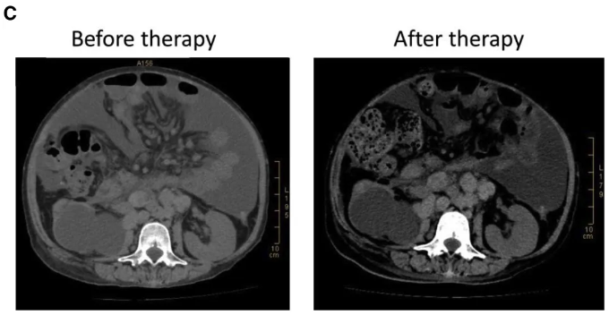 CAR-NK治疗转移性结直肠癌的效果