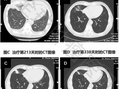 WT1-DC疫苗为终末期肺癌患者带来曙光,无进展生存期超577天