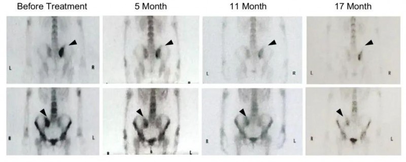 MASCT治疗宫颈癌前后对比