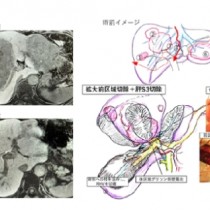 确诊肠癌后先别着急切！看看日本的高水平精密手术是如何做的