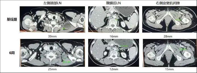 TIL细胞免疫疗法治疗卵巢癌的效果