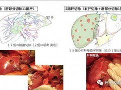日本肝癌5年生存率为何远超中国?肝癌去日本治疗能否博得一线生机?