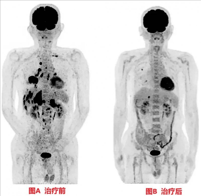 日本树突疫苗治疗效果