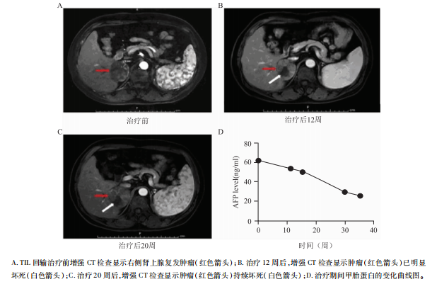 TIL疗法治疗肝癌双肾上腺转移的效果