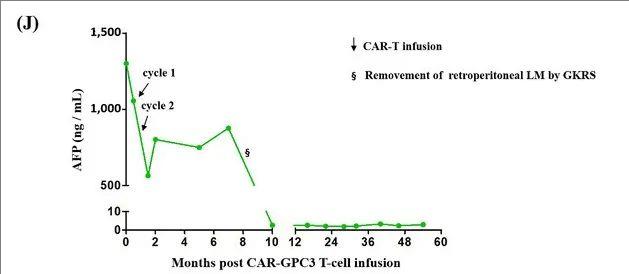 CAR-GPC3 T细胞疗法治疗晚期肝癌的数据