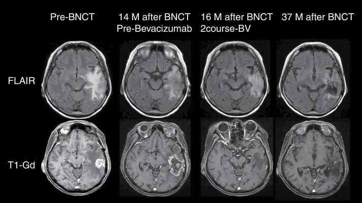 BNCT硼中子治疗胶质母细胞瘤的效果