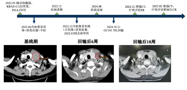 GC101 TIL细胞疗法治疗肺腺癌的效果