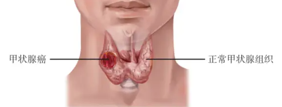 甲状腺癌和正常甲状腺组织对比