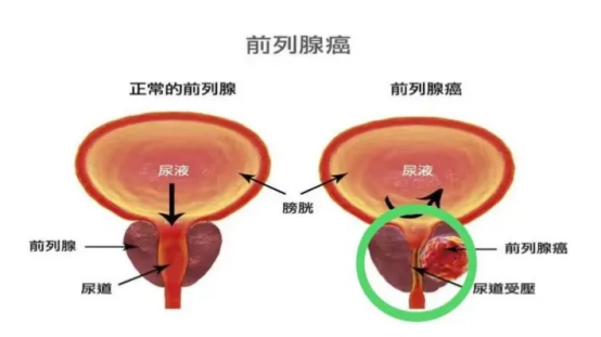 前列腺癌