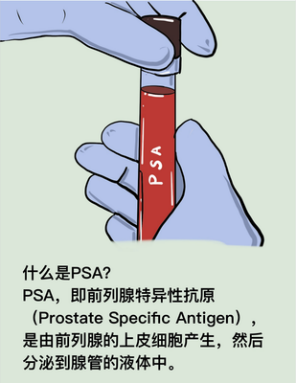 前列腺癌PSA检测是什么