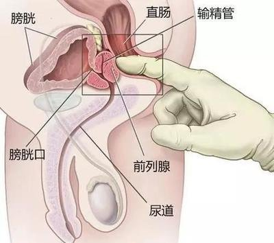 前列腺癌直肠指检