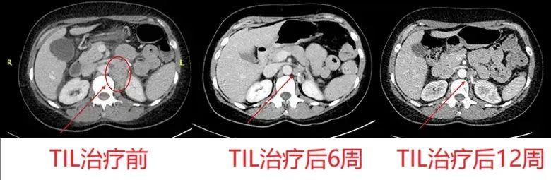 结膜黑色素瘤