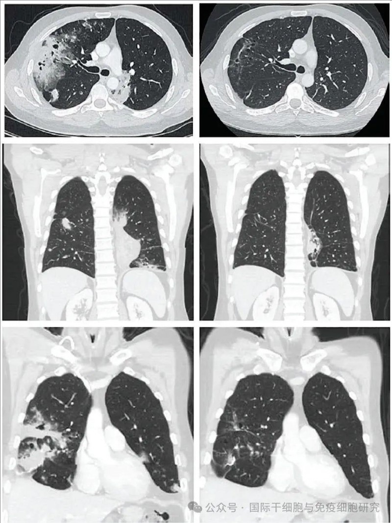 TIL细胞疗法治疗肺粘液腺癌的效果