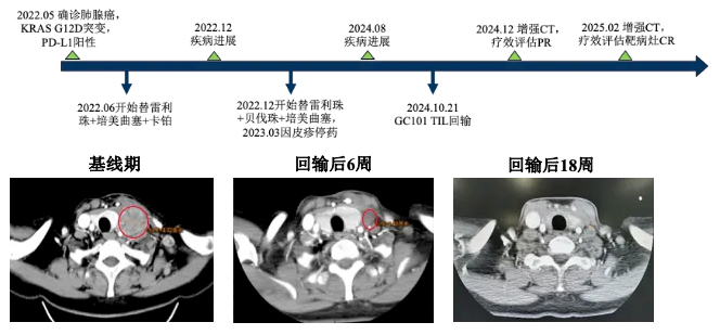 TIL疗法治疗肺癌的效果