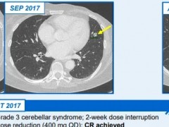 NTRK抑制剂恩曲替尼(Entrectinib)治疗分泌性乳腺癌,一个月实现完全缓解,客观缓解率高达100%