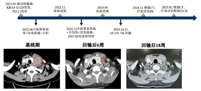 TIL细胞疗法治疗肺癌的效果