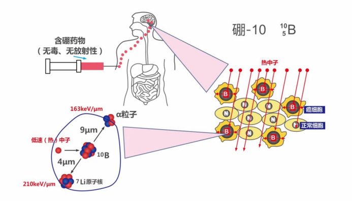 硼中子复活疗法