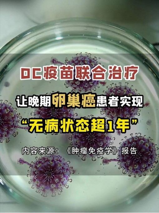 《肿瘤免疫学》最新研究：DC疫苗联合治疗，让晚期卵巢癌患者实现“无病状态超1年”！ #DC疫苗 #卵巢癌 #肿瘤免疫